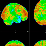 Neuro PET/CT