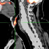 Oncology PET/CT