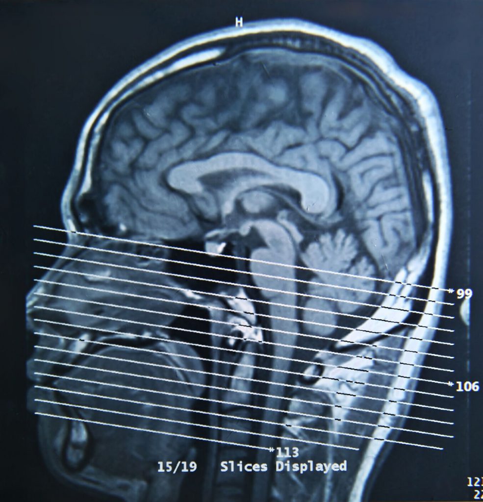 MRI brain interpretation