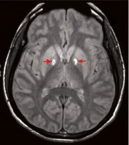 http://picturespider.com/i-pictures-of-brain-mri-with-lesions.php