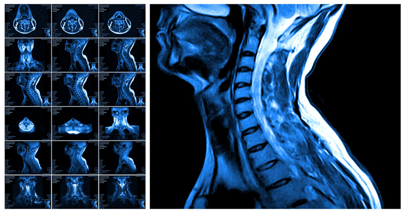 MRI spine interpretation